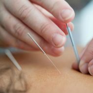 Acupuncture for Motor Vehicle Accident (3)